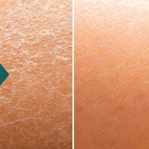 lp_acne_10
