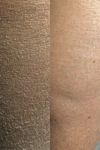 dry-skin